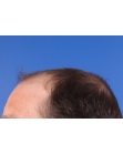Before Hair Transplant&nbsp;2 Sessions (Areas)